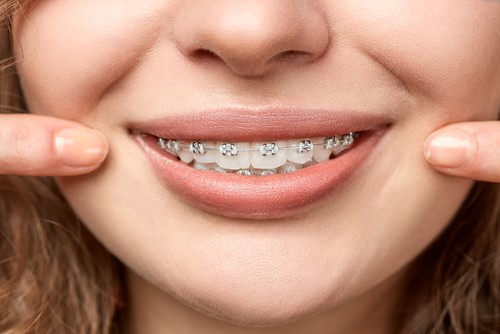 Konya Diş Teli (Şeffaf Diş Teli) Ücretleri 2024 - Ortodonti Uzmanı