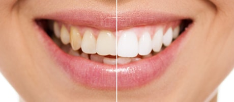 Konya Ortodonti Uzmanı - Diş Bozuklukları için Ortodonti